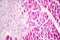 Acute myocardial infarction, histology of heart tissue