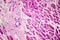 Acute myocardial infarction, histology of heart tissue, light micrograph