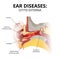 acute otitis externa, sectional image on white background