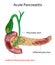 Acute Pancreatitis