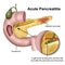 Acute pancreatitis 3d medical  illustration on white background
