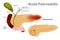 Acute Pancreatitis caused. Gallstones block the flow of pancreatic juices into the duodenum.