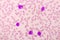 Acute promyelocytic leukemia cells or APL