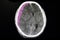 acute subdural hematoma