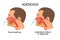 Adenoiditis, respiratory failure