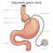 Adjustable gastric band diagram medical science