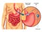 Adjustable Gastric Banding