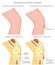 Adolescent knee pain_Osgood Schlatter disease