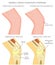 Adolescent knee pain_Sinding Larsen Johansson Syndrome