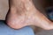 Adult man`s foot with varicose veins