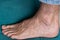 Adult man`s foot with varicose veins