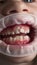 Adult permanent teeth coming in front of the child`s baby teeth: shark teeth