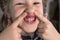 Adult permanent teeth coming in front of the child`s baby teeth: shark teeth