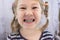 Adult permanent teeth coming in front of the child`s baby teeth: shark teeth