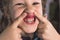 Adult permanent teeth coming in front of the child`s baby teeth: shark teeth