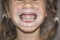 Adult permanent teeth coming in front of the child`s baby teeth: shark teeth