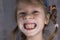 Adult permanent teeth coming in front of the child`s baby teeth: shark teeth