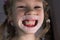 Adult permanent teeth coming in front of the child`s baby teeth: shark teeth