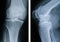 Advanced osteoarthritis