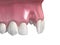 Aesthetic defect after losing central incisor tooth. Medically accurate 3D illustration of human teeth and dentures concept