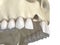 Aesthetic defect after losing central incisor tooth. Medically accurate 3D illustration of human teeth and dentures concept