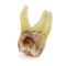 affected by caries, destroyed with a large cavity, removed human tooth with large roots, chewing molar tooth, wisdom tooth, tooth