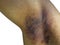 The Affected skin, Armpit Underarm Rash infections ringworm, bacterial folliculitis, hidradenitis suppurativa