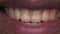 African American man shows yellow teeth