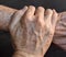 Age spots on hands. They are brown, gray, or black spots and also called liver spots, senile lentigo, solar lentigines, or sun