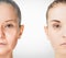 Aging process, rejuvenation anti-aging skin procedures