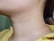 Aging skin folds or skin creases or wrinkles at neck of Southeast Asian, Chinese young woman