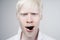 Albinism albino man in studio dressed t-shirt isolated on a white background. abnormal deviations. unusual appearance