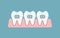 Alignment of bite of teeth, dental row  with braces,  Orthodontic, stomatology concept.