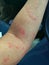 Allergic dermatitis allergic food allergic skin rash allergic dermatitis