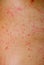 Allergic rash dermatitis skin