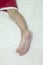 Allergic rash skin of baby`s right foot