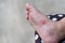 Allergic rash skin of baby`s right foot.
