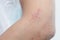 Allergic skin lesions on the arms Thailand Asian women.