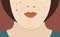 Allergy rash and red blister on woman face vector illustration