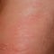 Allergy skin back and sides. Allergic reactions on the skin in the form of swelling and