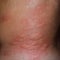 Allergy skin back and sides. Allergic reactions on the skin in the form of swelling and