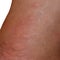 Allergy skin back and sides. Allergic reactions on the skin in the form of swelling and