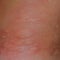 Allergy skin back and sides. Allergic reactions on the skin in the form of swelling and