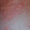 Allergy skin back and sides. Allergic reactions on the skin in the form of swelling and