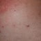 Allergy skin back and sides. Allergic reactions on the skin in the form of swelling and