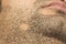 Alopecia Areata hair loss on cheek beard in a patch