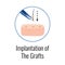 Alopecia Grafts Implantation Composition