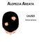 Alopecia hair. Baldness of hair on the head. Alopecia areata causes. Infographics. Vector illustration on isolated