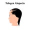 Alopecia hair. Baldness of hair on the head. Telogen Alopecia. Infographics. Vector illustration on isolated background.
