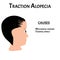 Alopecia hair. Baldness of hair on the head. Traction alopecia causes. Infographics. Vector illustration on isolated